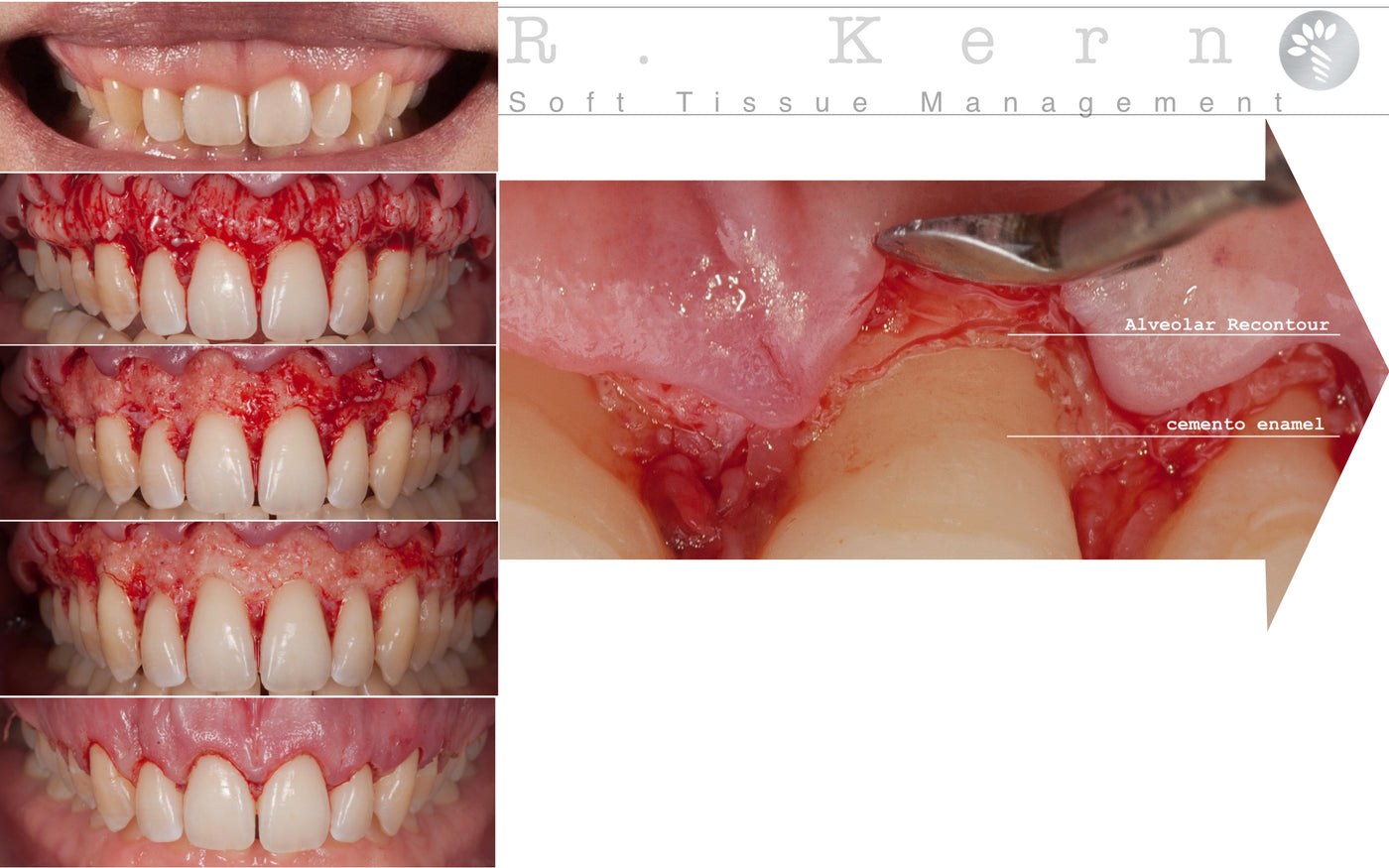 Soft Tissue Surgery Course with Dr. Ricardo Kern - Advanced Course